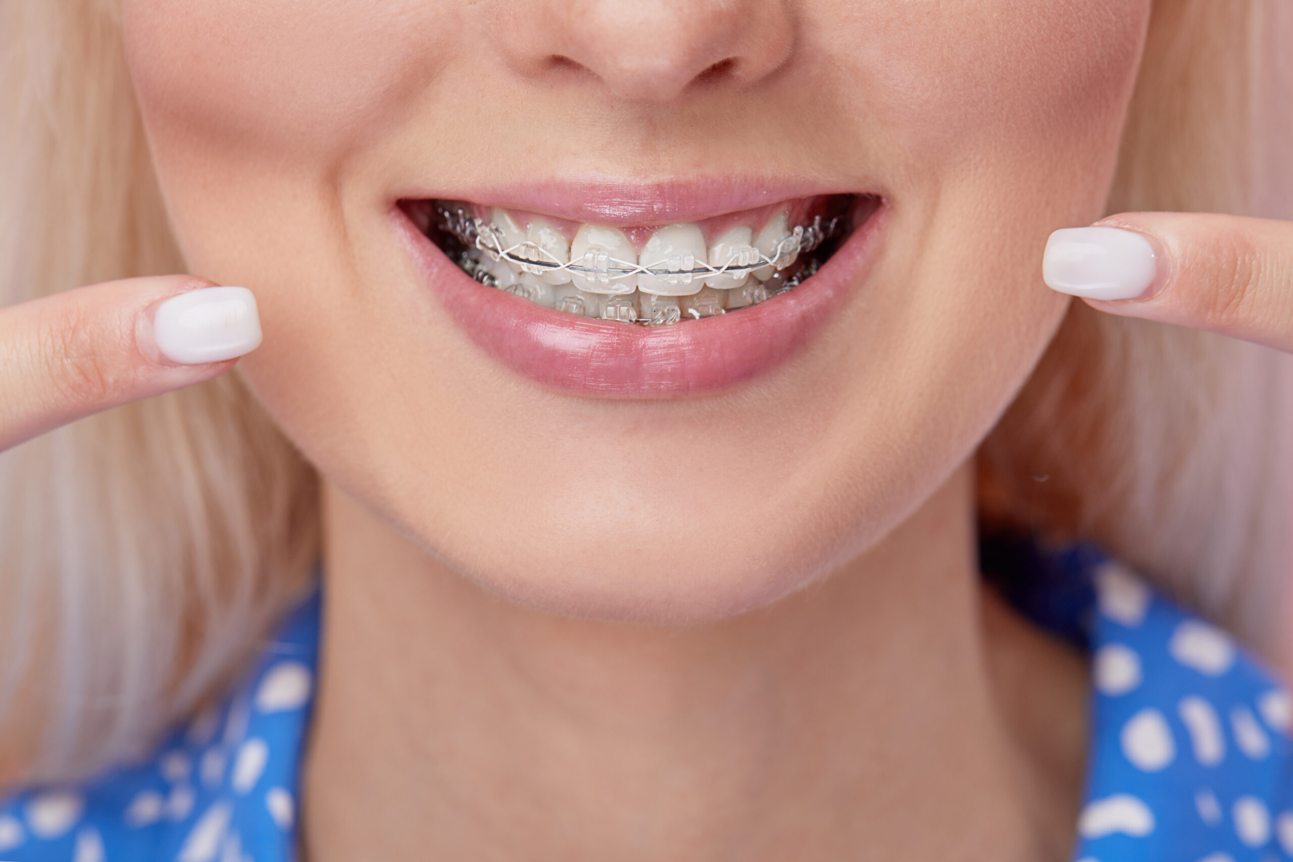 Adult orthodontic treatment close-up