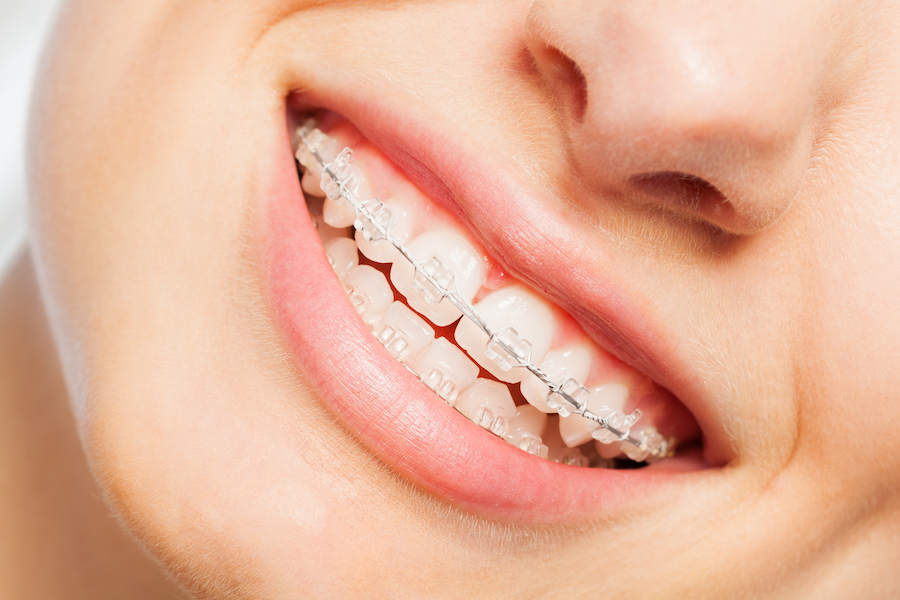 Clear ceramic braces close-up