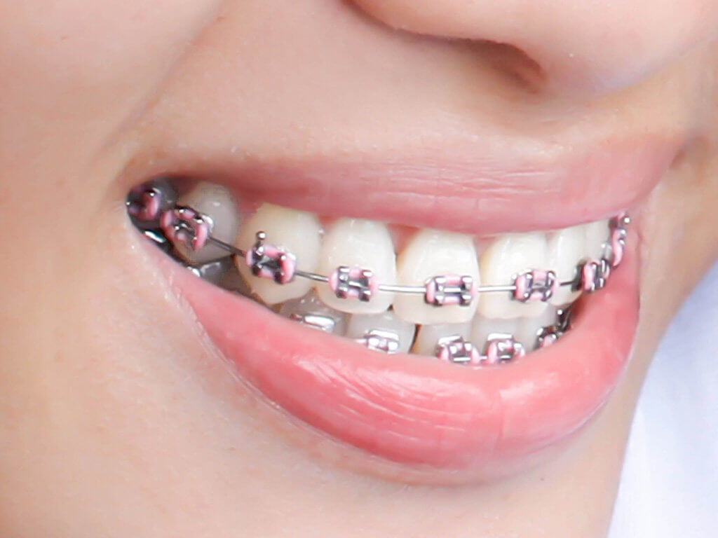 Traditional braces close-up